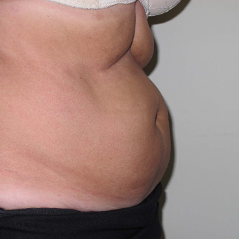 Side view of female patient prior to Abdominoplasty Surgery
